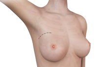 Breast Surgery