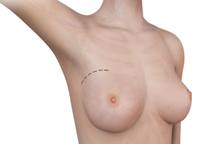 Breast Surgery 