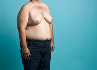 Gynecomastia