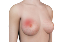 Breast Infection