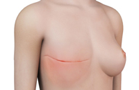 Mastectomy