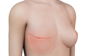 Mastectomy