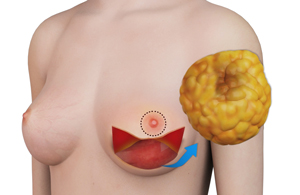 Nipple-sparing Mastectomy With Inframammary Cut - Health Library