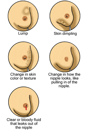 Breast Self Examination BSE