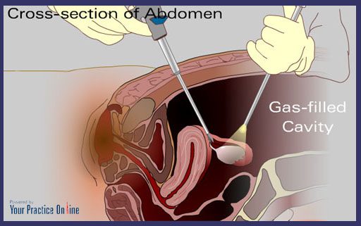 laparoscopy